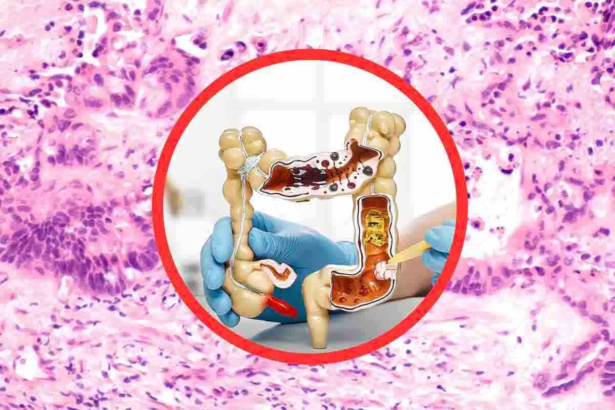 tumore al colon retto sintomi precoci